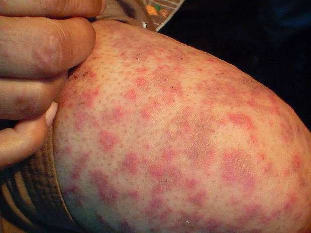 Granuloma Annulare - American Osteopathic College of ...