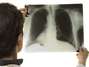 Tuberculosis: segunda causa de muerte infecciosa del mundo